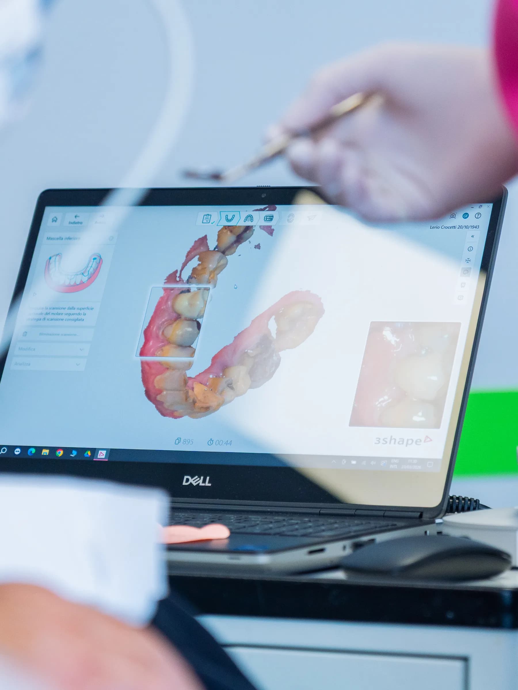 Scansione intraorale in corso da White: l'arcata dentale ricostruita in 3D sullo schermo