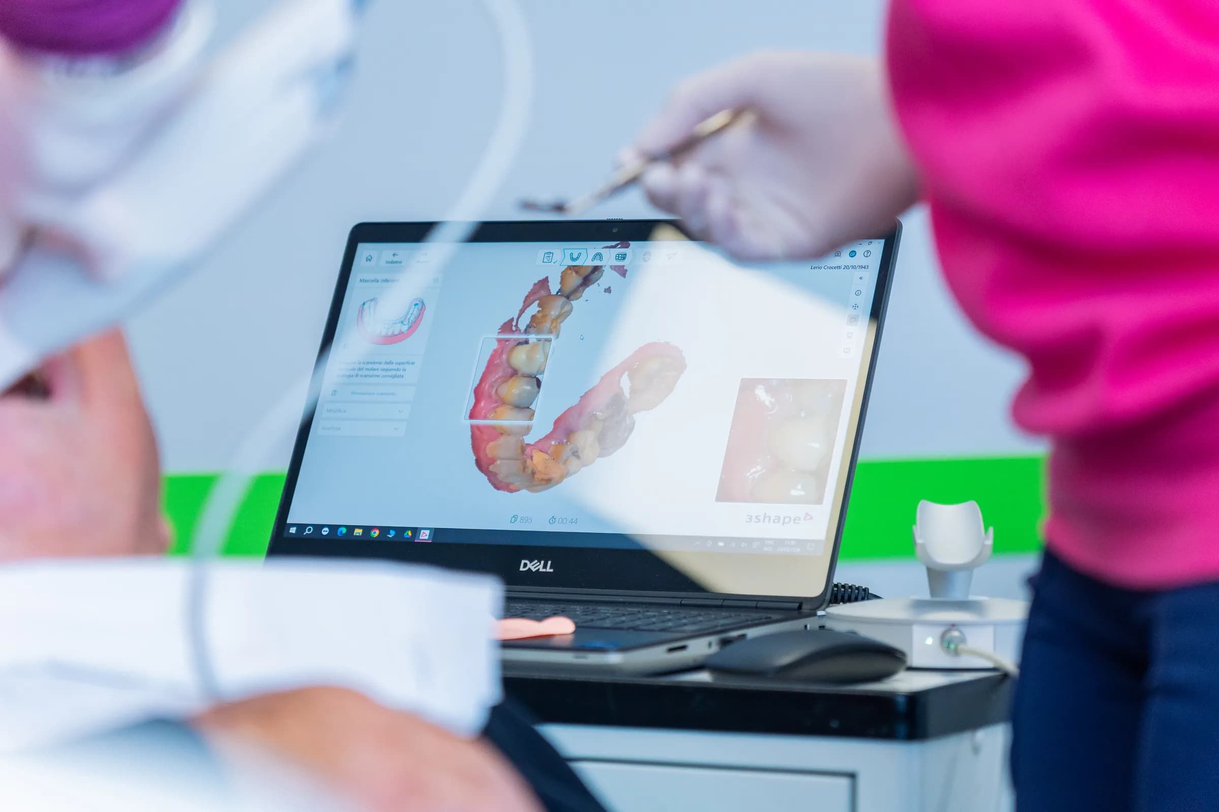 Scansione intraorale in corso da White: l'arcata dentale ricostruita in 3D sullo schermo